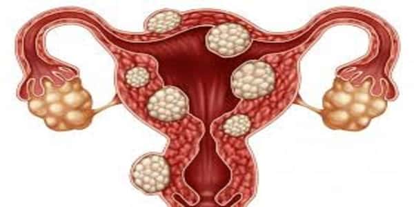 Available Treatment Options for Fibroids