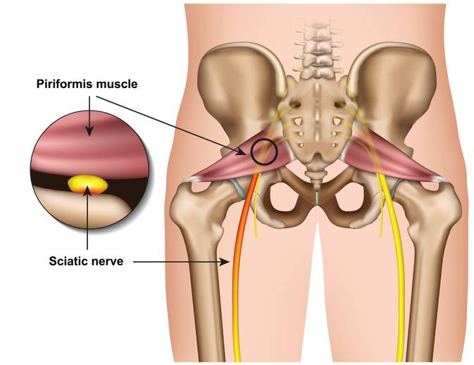 How is Sciatica Disorder Diagnosed?