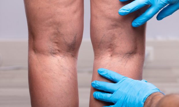 What You Should Know About Varicose Veins