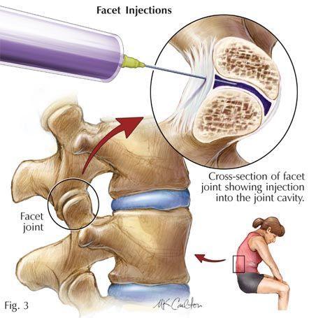 What Everybody Needs to Know About Facet Joint Syndrome
