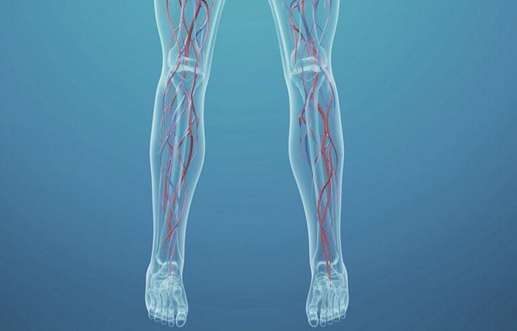 Peripheral Arterial Disease – Causes, Treatment, And More!