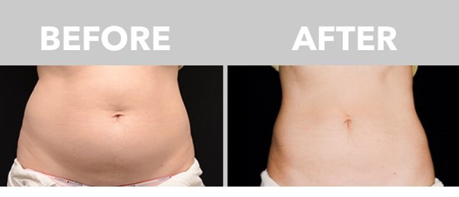 Who is A Good Candidate for a CoolSculpting Procedure?