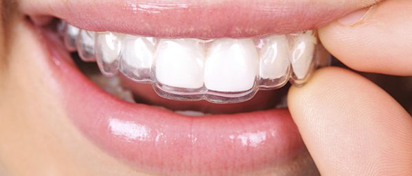 Differences Between Invisalign Treatment and Traditional Braces
