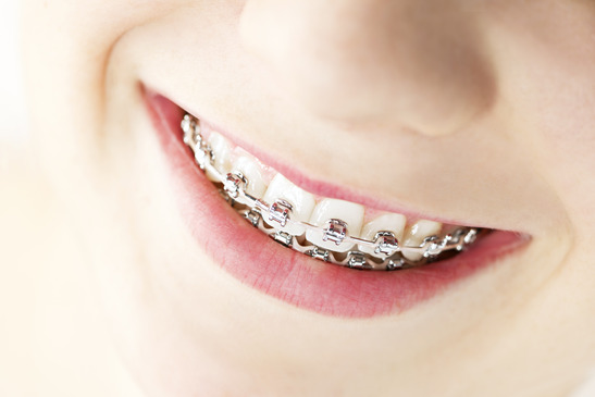 Orthodontic Treatment Options to Give Your Child a Lasting Beautiful Smile