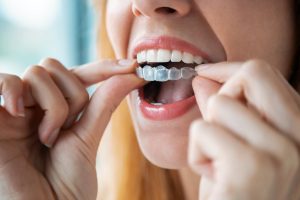 Understanding Teeth Aligners