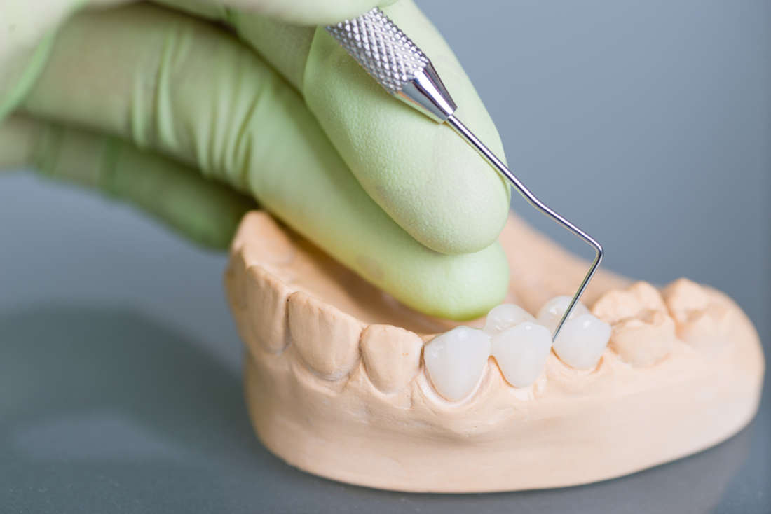 Advantages of Dental Crowns and Bridges