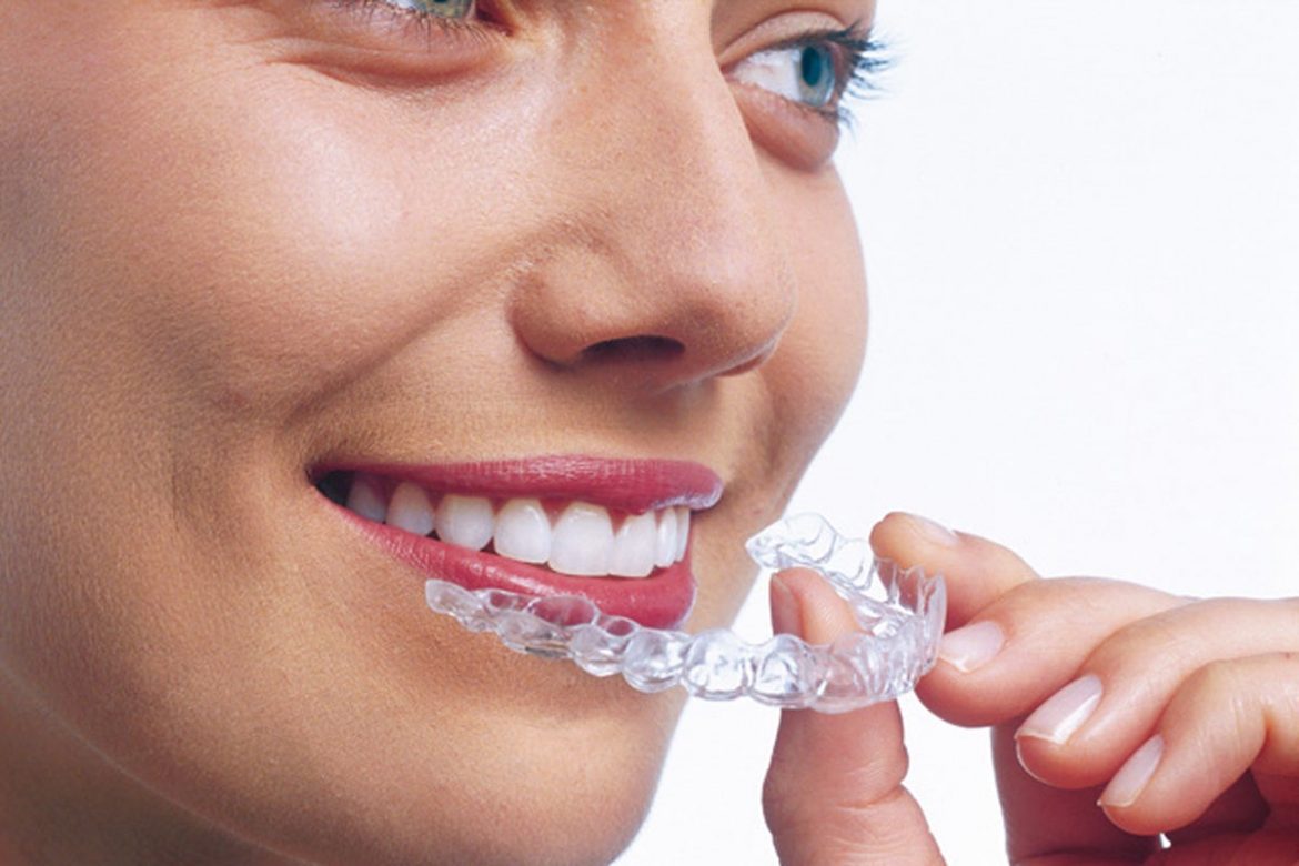 5 Invisalign Myths You Should Know